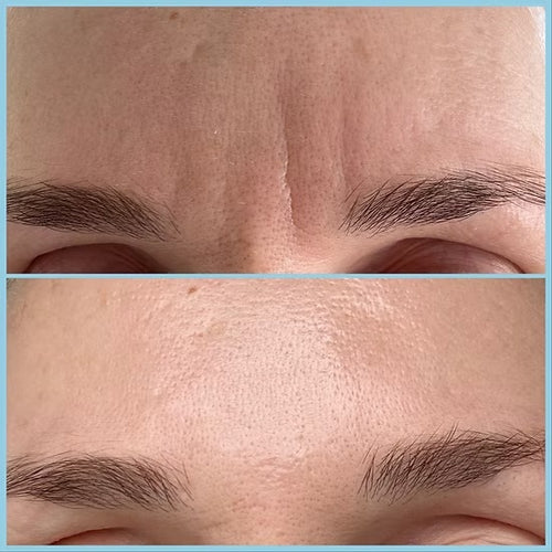 Before and after comparison of eyebrow grooming on a person's forehead, showing a fuller, darker eyebrow in the bottom panel and a sparser, lighter eyebrow in the top panel.