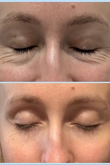 A close-up before-and-after comparison of a woman's eye area, showing dark under-eye circles and wrinkles in the top photo and a smoother, brighter result in the bottom photo.